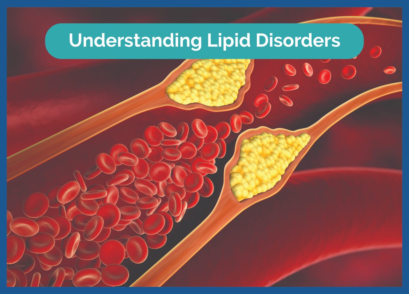 Cholesterol and lipid disorders