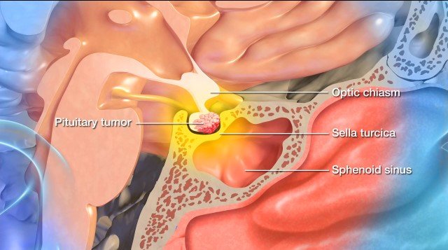 Pituitary tumors and neuroendocrine disorders